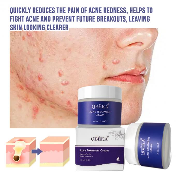 Verlichting en herstel van acne littekens Natuurlijke organische acne behandeling crème Hoeveelheid 1000 5