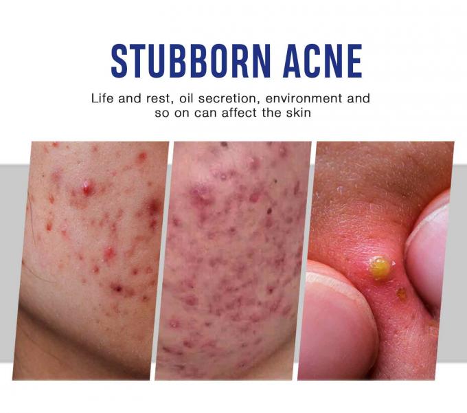 Verlichting en herstel van acne littekens Natuurlijke organische acne behandeling crème Hoeveelheid 1000 7