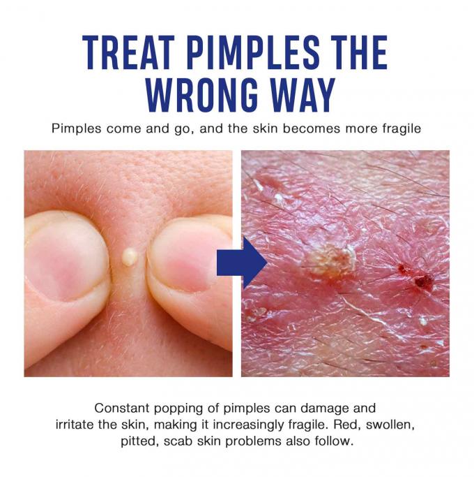Verlichting en herstel van acne littekens Natuurlijke organische acne behandeling crème Hoeveelheid 1000 8