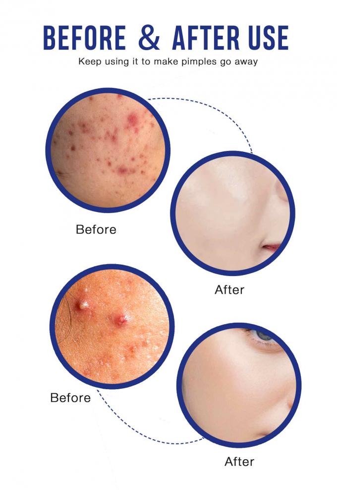 Verlichting en herstel van acne littekens Natuurlijke organische acne behandeling crème Hoeveelheid 1000 9