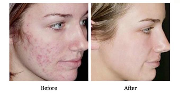 Voordelen van QBEKA Proteinpeptide Serum Waterretentie en Acne Scar Repair 10 ml 6